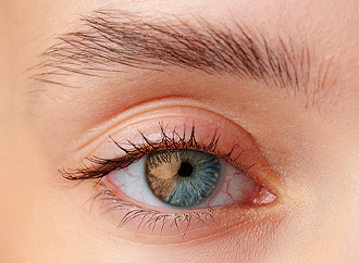 Keratopigmentation